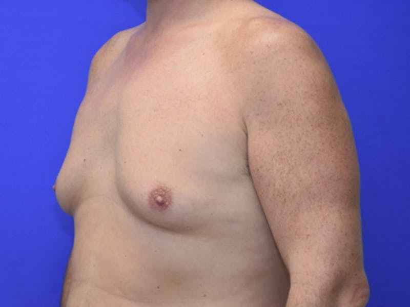 Gynecomastia Before & After Gallery - Patient 534593 - Image 3