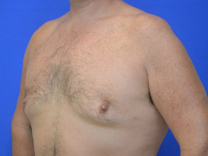 Gynecomastia Before & After Gallery - Patient 534593 - Image 4