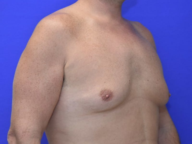 Gynecomastia Before & After Gallery - Patient 534593 - Image 5