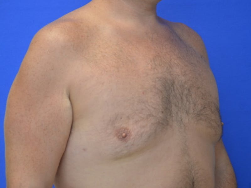Gynecomastia Before & After Gallery - Patient 534593 - Image 6