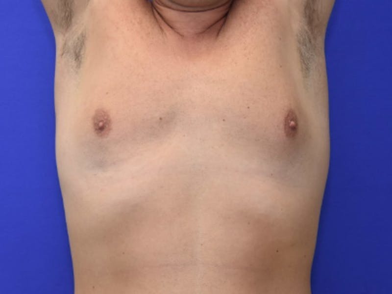 Gynecomastia Before & After Gallery - Patient 534593 - Image 7