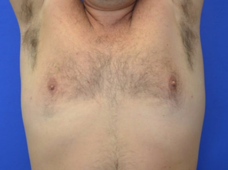 Gynecomastia Before & After Gallery - Patient 534593 - Image 8