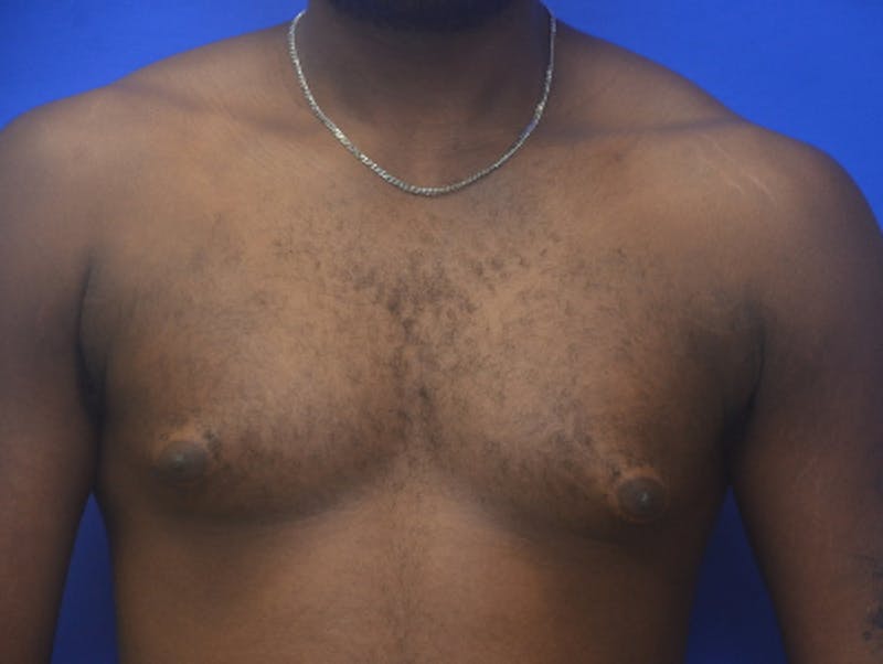 Gynecomastia Before & After Gallery - Patient 233114 - Image 1