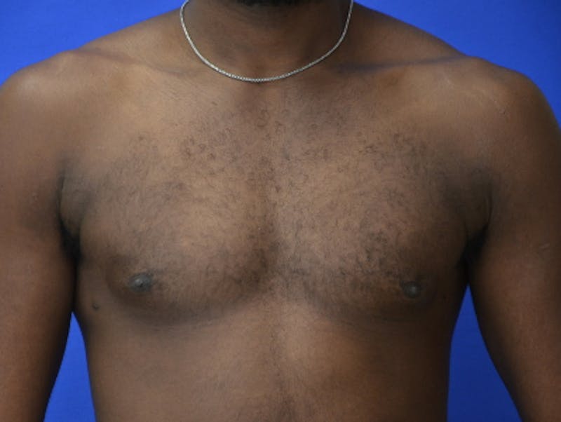 Gynecomastia Before & After Gallery - Patient 233114 - Image 2