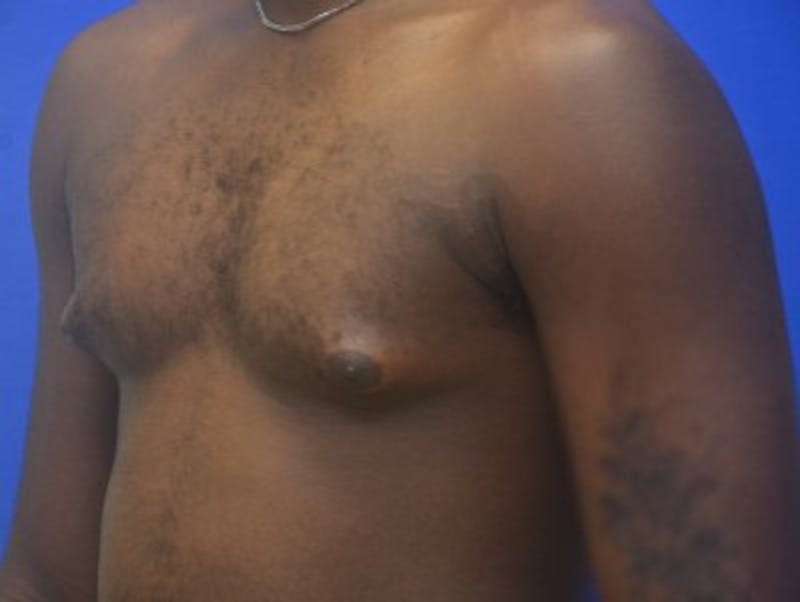 Gynecomastia Before & After Gallery - Patient 233114 - Image 3