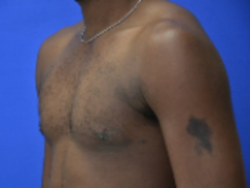 Gynecomastia Before & After Gallery - Patient 233114 - Image 4