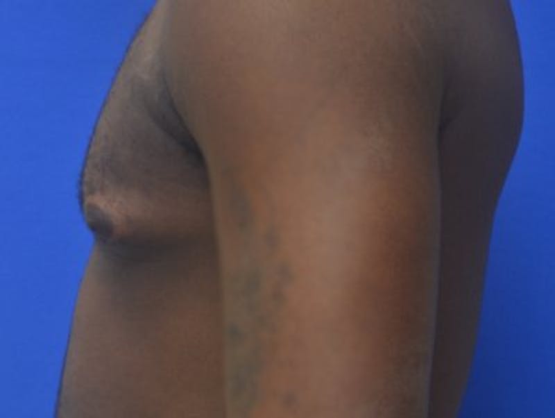 Gynecomastia Before & After Gallery - Patient 233114 - Image 5
