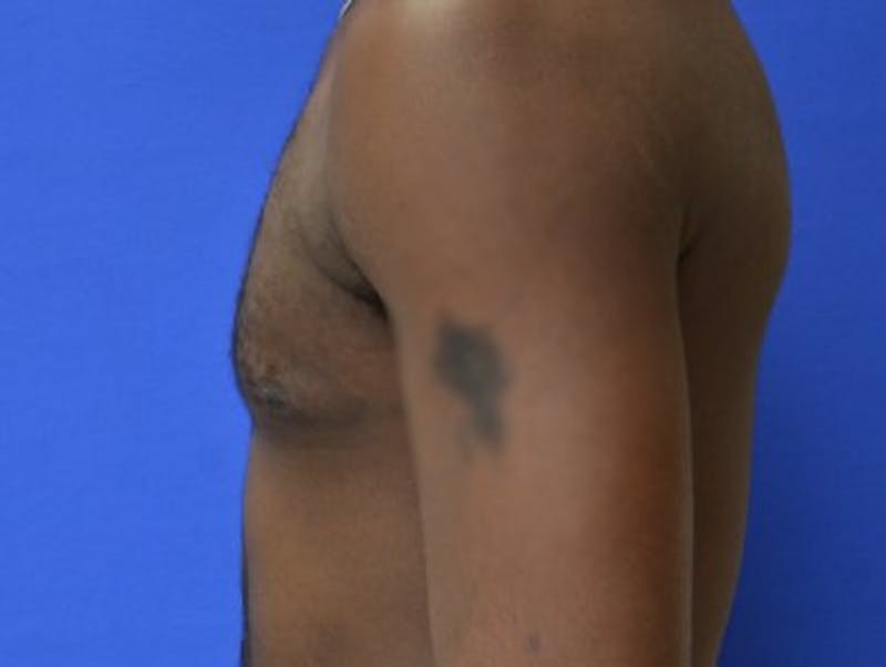 Gynecomastia Before & After Gallery - Patient 233114 - Image 6