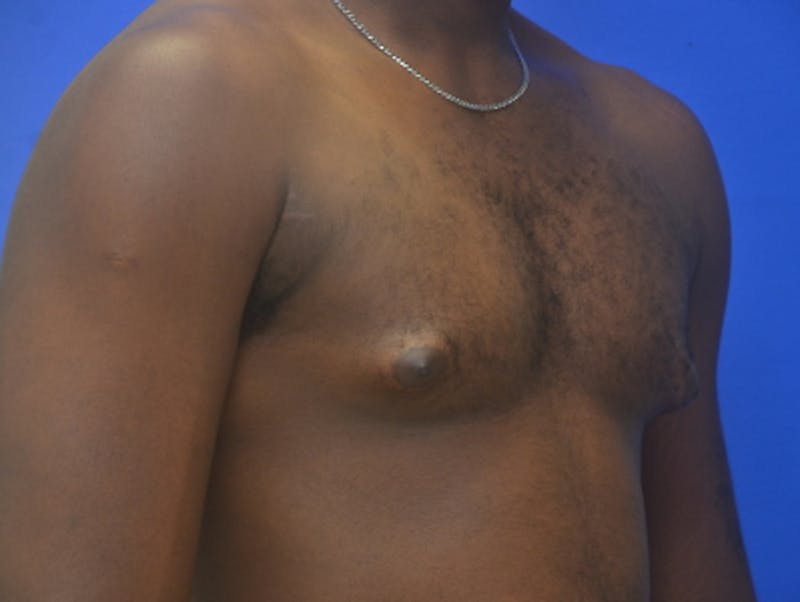 Gynecomastia Before & After Gallery - Patient 233114 - Image 7