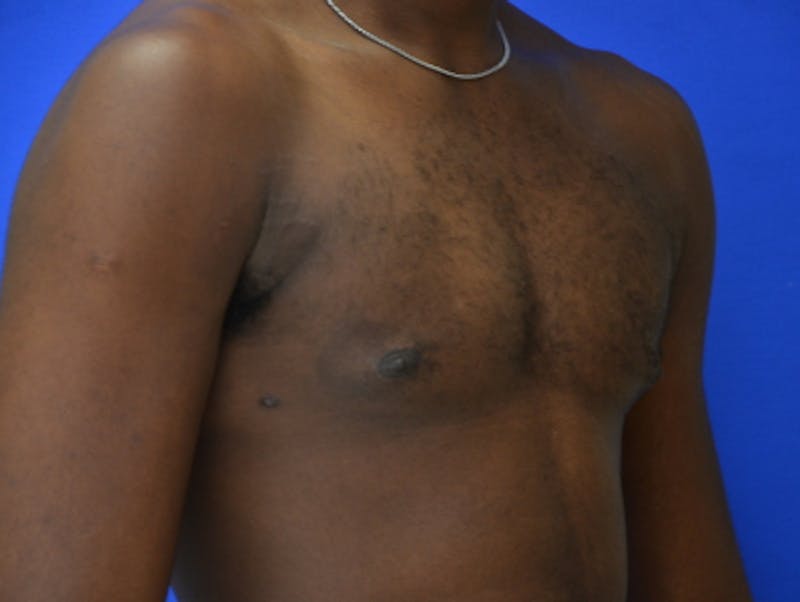 Gynecomastia Before & After Gallery - Patient 233114 - Image 8