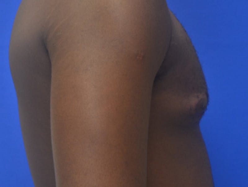 Gynecomastia Before & After Gallery - Patient 233114 - Image 9