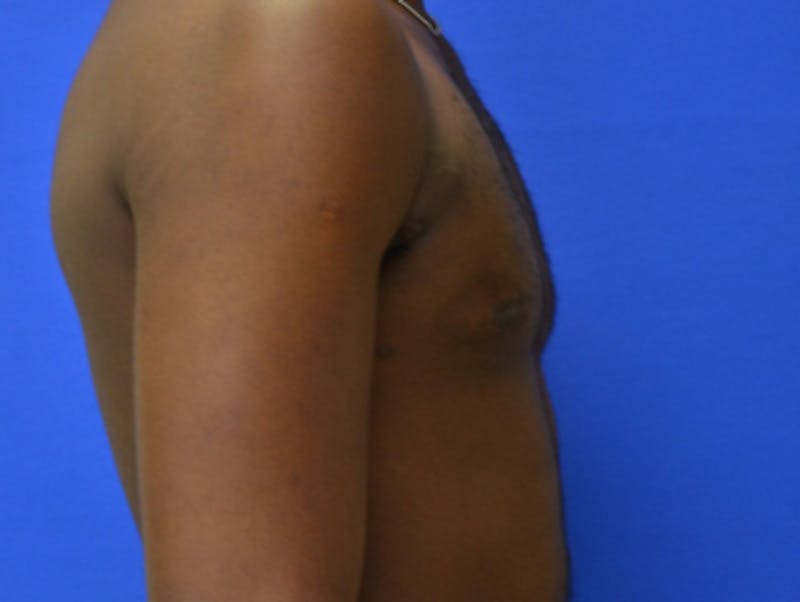 Gynecomastia Before & After Gallery - Patient 233114 - Image 10