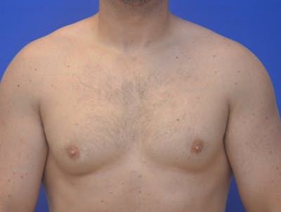 Gynecomastia Before & After Gallery - Patient 357985 - Image 1