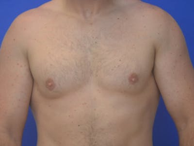 Gynecomastia Before & After Gallery - Patient 357985 - Image 2