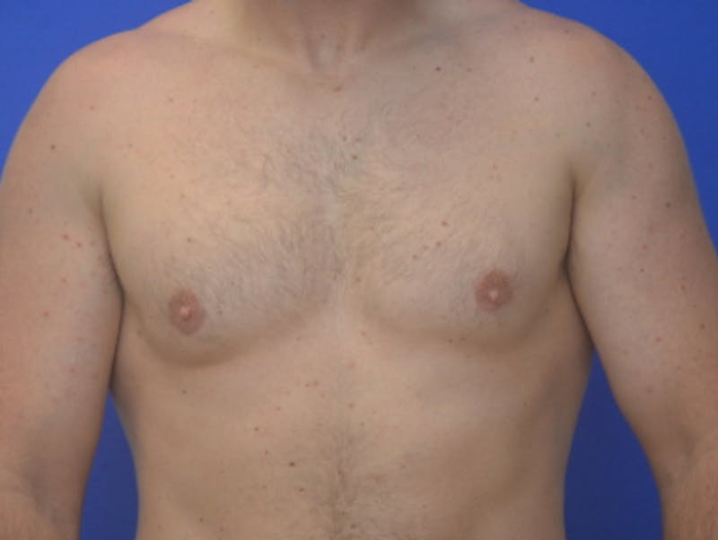 Gynecomastia Before & After Gallery - Patient 357985 - Image 2