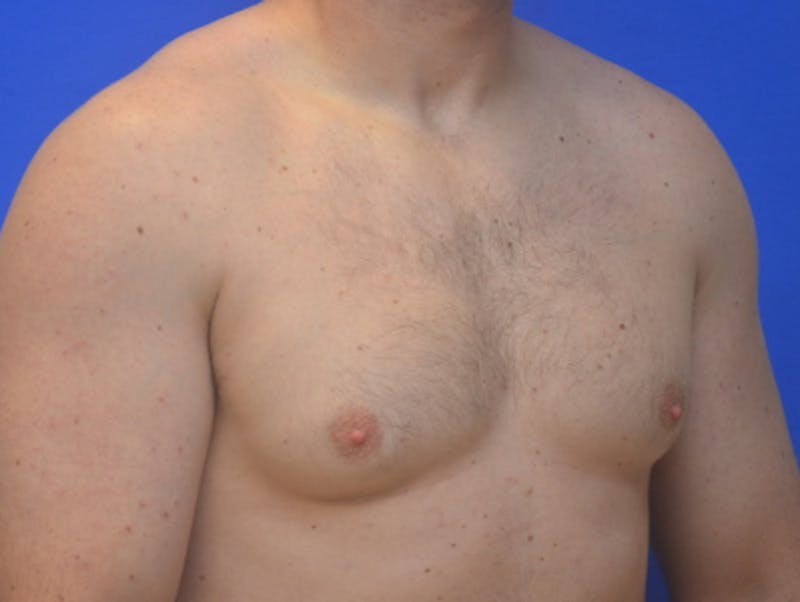 Gynecomastia Before & After Gallery - Patient 357985 - Image 3