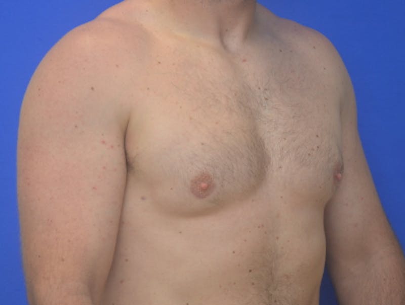 Gynecomastia Before & After Gallery - Patient 357985 - Image 4