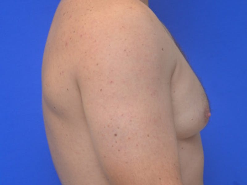 Gynecomastia Before & After Gallery - Patient 357985 - Image 5