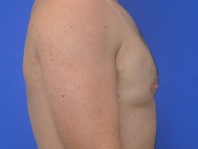 Gynecomastia Before & After Gallery - Patient 357985 - Image 6