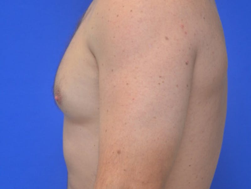 Gynecomastia Before & After Gallery - Patient 357985 - Image 7