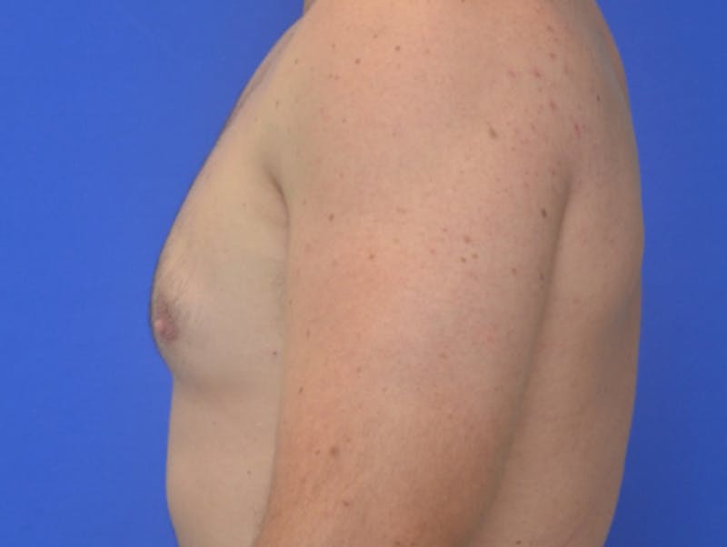 Gynecomastia Before & After Gallery - Patient 357985 - Image 8