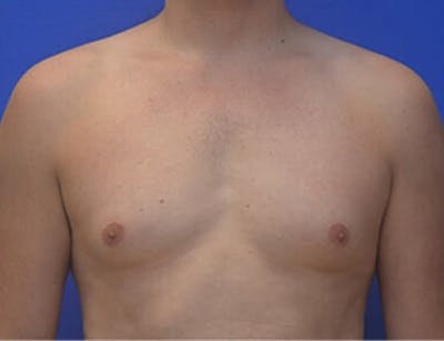 Gynecomastia Before & After Gallery - Patient 110772 - Image 1