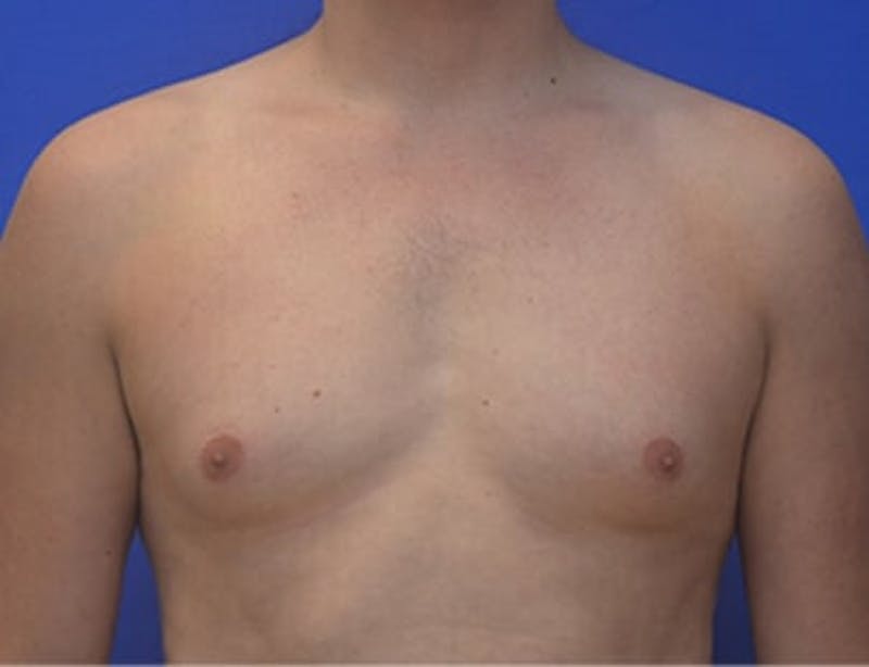 Gynecomastia Before & After Gallery - Patient 110772 - Image 1