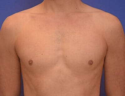 Gynecomastia Before & After Gallery - Patient 110772 - Image 2
