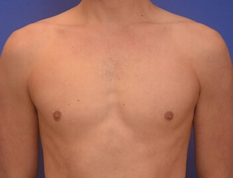 Gynecomastia Before & After Gallery - Patient 110772 - Image 2