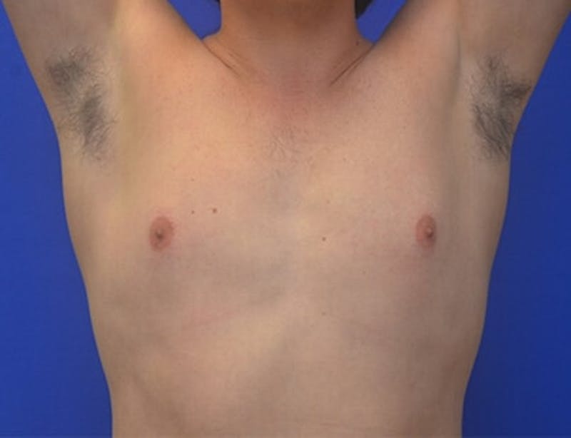 Gynecomastia Before & After Gallery - Patient 110772 - Image 3