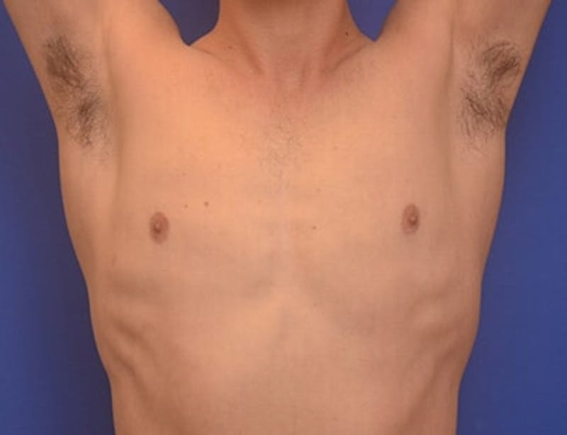Gynecomastia Before & After Gallery - Patient 110772 - Image 4