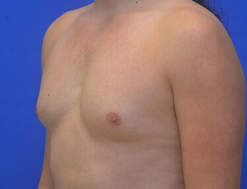 Gynecomastia Before & After Gallery - Patient 110772 - Image 5