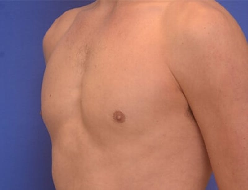 Gynecomastia Before & After Gallery - Patient 110772 - Image 6
