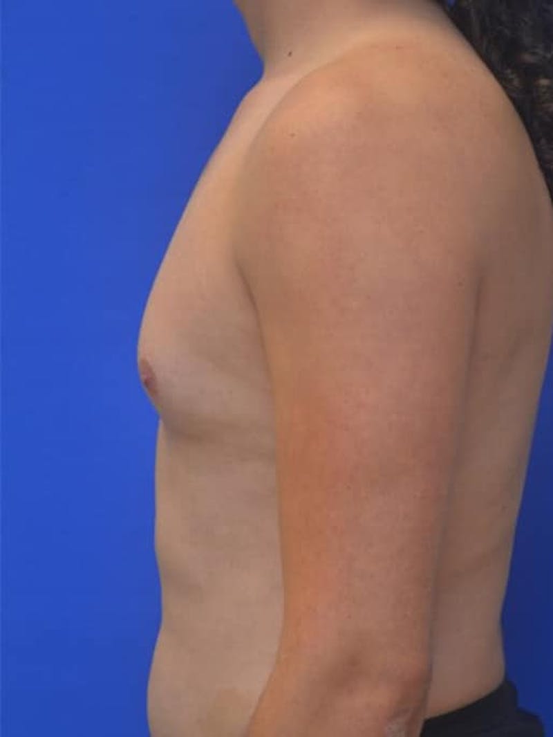 Gynecomastia Before & After Gallery - Patient 110772 - Image 7