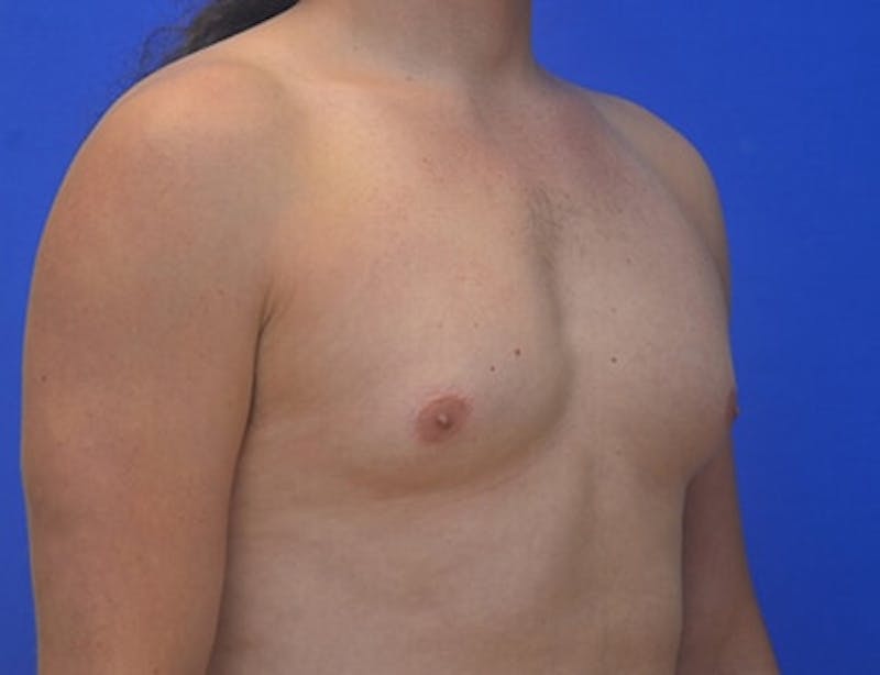 Gynecomastia Before & After Gallery - Patient 110772 - Image 11