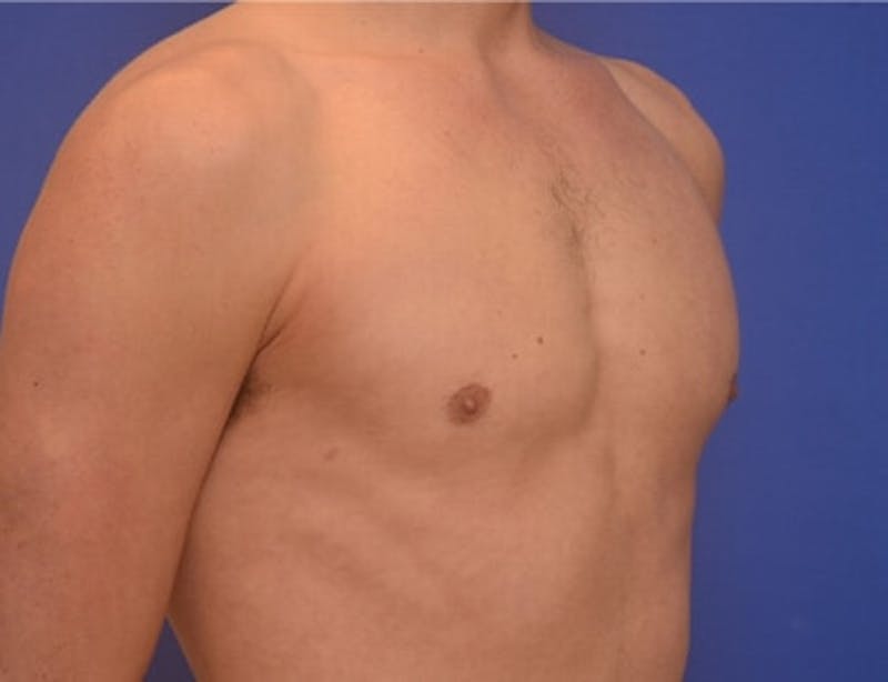 Gynecomastia Before & After Gallery - Patient 110772 - Image 12