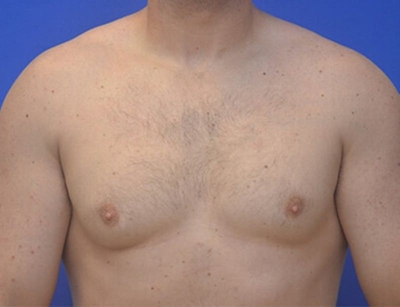 Gynecomastia Before & After Gallery - Patient 370621 - Image 1