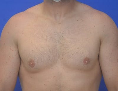 Gynecomastia Before & After Gallery - Patient 370621 - Image 2