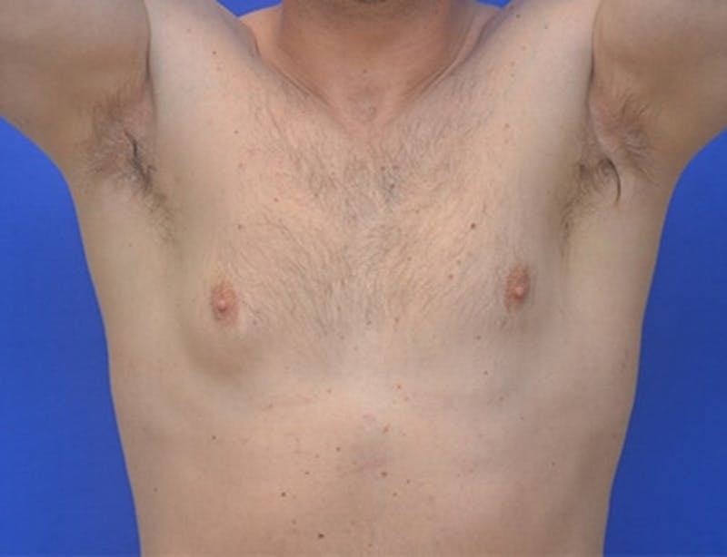 Gynecomastia Before & After Gallery - Patient 370621 - Image 3