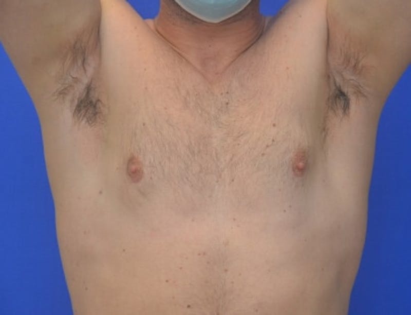 Gynecomastia Before & After Gallery - Patient 370621 - Image 4