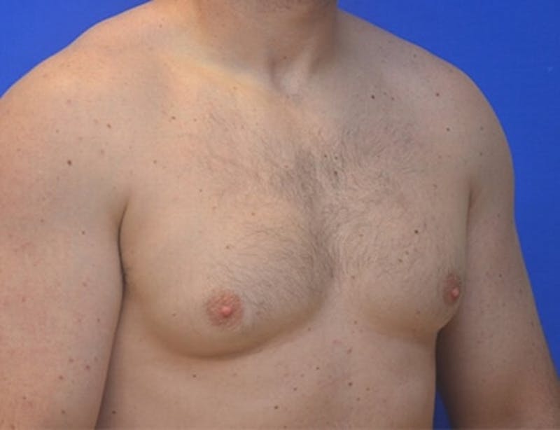 Gynecomastia Before & After Gallery - Patient 370621 - Image 5
