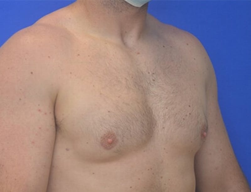 Gynecomastia Before & After Gallery - Patient 370621 - Image 6