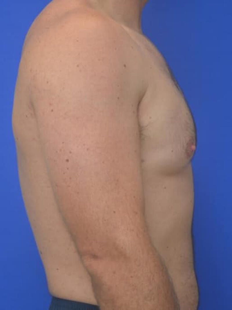 Gynecomastia Before & After Gallery - Patient 370621 - Image 7