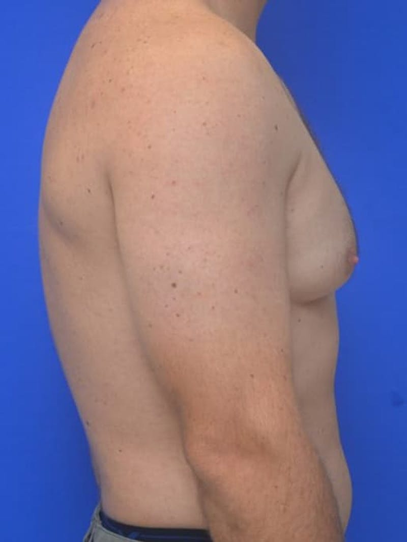 Gynecomastia Before & After Gallery - Patient 370621 - Image 8