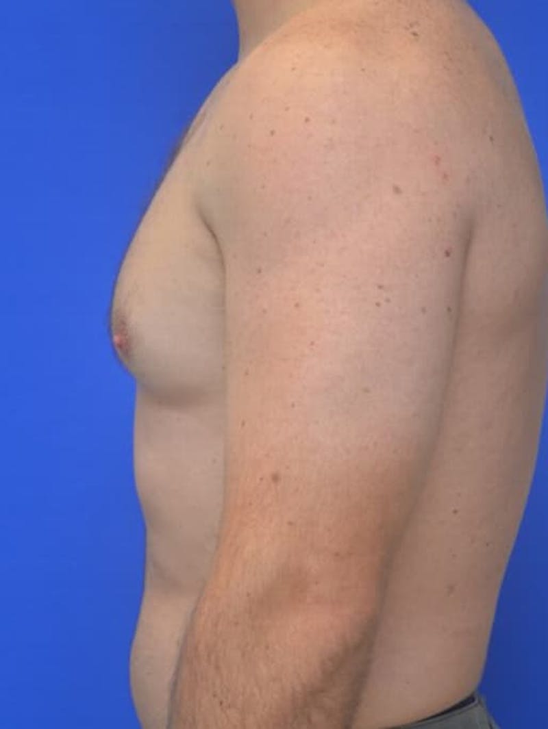 Gynecomastia Before & After Gallery - Patient 370621 - Image 9
