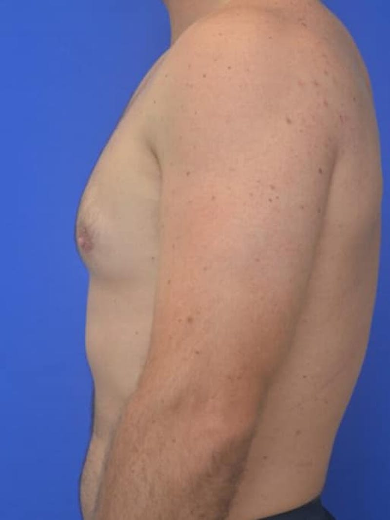 Gynecomastia Before & After Gallery - Patient 370621 - Image 10