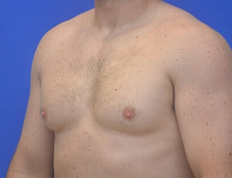 Gynecomastia Before & After Gallery - Patient 370621 - Image 11
