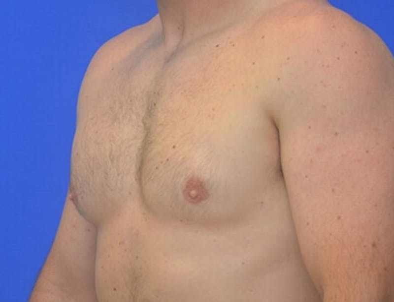 Gynecomastia Before & After Gallery - Patient 370621 - Image 12