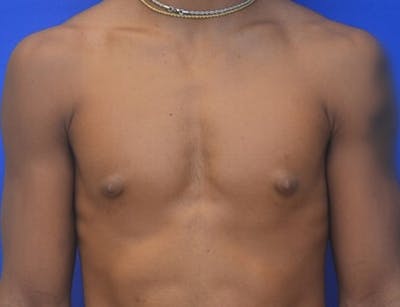 Gynecomastia Before & After Gallery - Patient 556776 - Image 1
