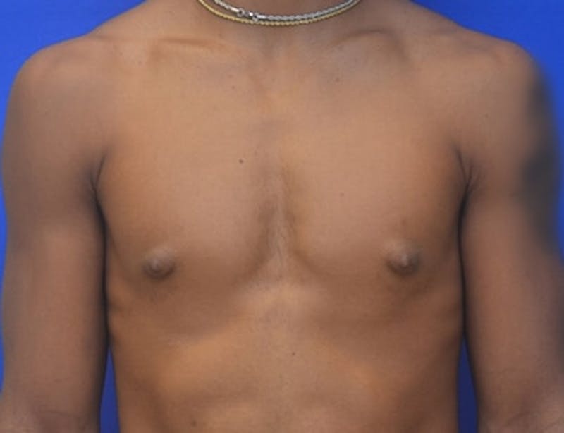 Gynecomastia Before & After Gallery - Patient 556776 - Image 1